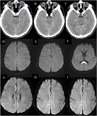 Frontiers Case Report High Dose Steroid And Ivig Successful